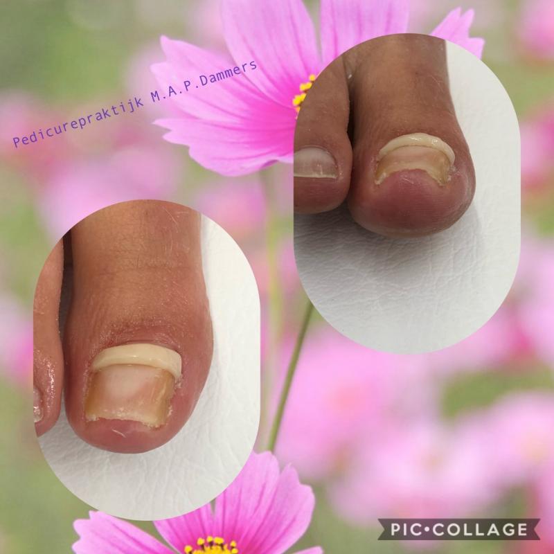 Composiet op de nagel