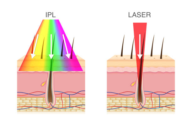 verschil laser en IPL ontharing
