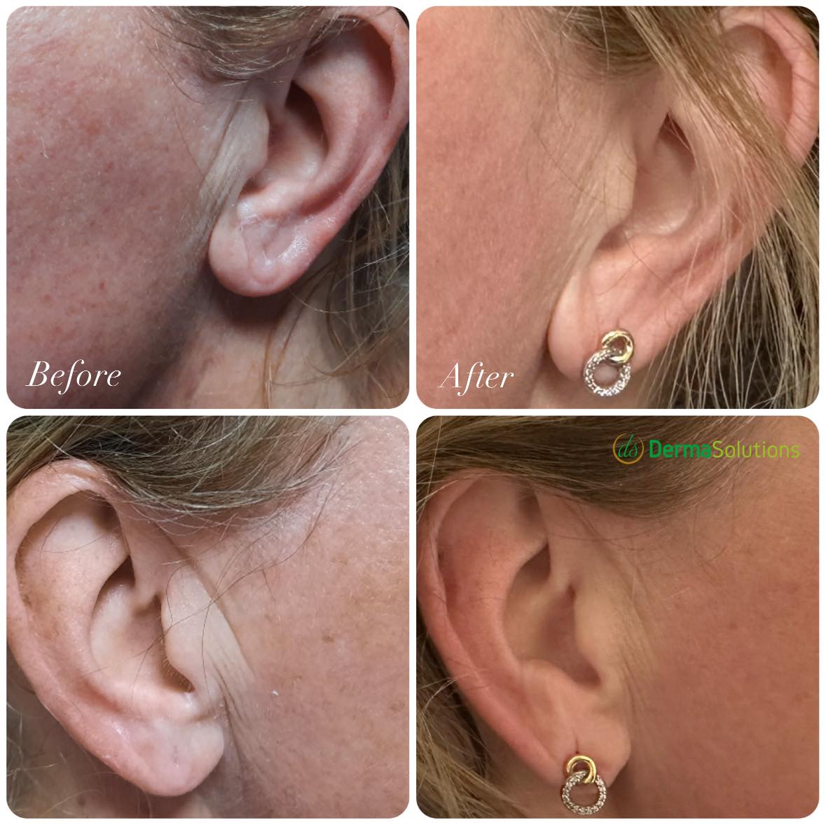 oorplooien oor lift plasma lift plexr fibroblasting plasmage